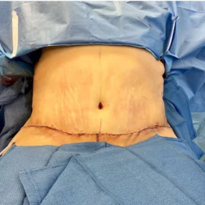 tummytuck-paklistan