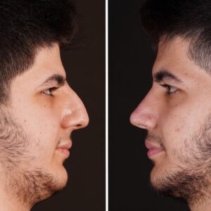 chin-surgery