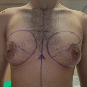 gynecomastia