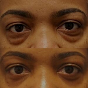 eyelid-surgery